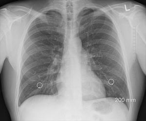 Brug CBD olier lungebetændelse, astma KOL